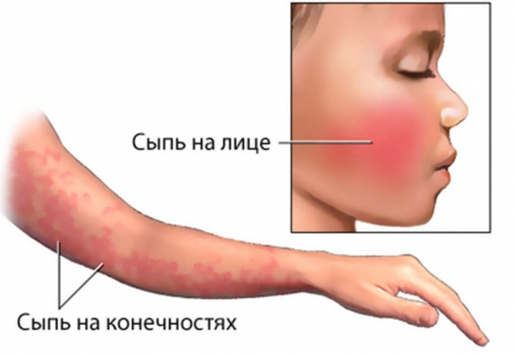 Вторичные морфологические элементы сыпи – показатели регресса болезни