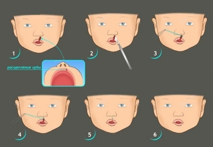 Заячья губа – причины, симптомы и лечение расщелины губы