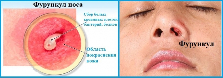 фурункул у носі