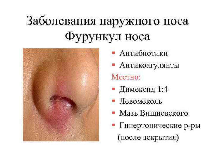 фурункул у носі