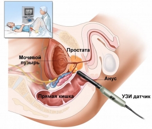aktualnye-metody-lecheniya-venoznogo-zastoya-krovi-v-malom-tazu- u-muzhchin