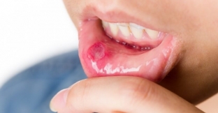allergicheskij-stomatit-osnovnye-simptomy-i-printsipy-lecheniya