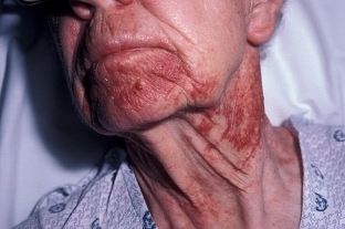 amiloidoz-kozhi-kharakternye-simptomy-sereznoj-patologii