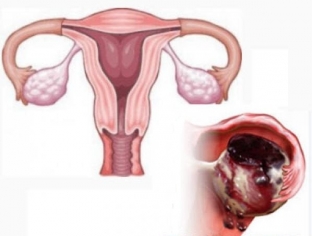apopleksiya-yaichnika-pochemu-ovarialnaya-tkan-mozhet-razryvatsya