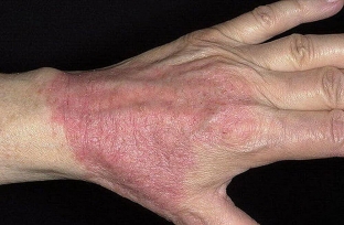 atopicheskij-dermatit-u-vzroslykh-prichiny-simptomy-i-le /></p>
<p>Причини, які можуть спровокувати появу симптомів атопічного дерматиту у дорослих:</p>
<ul>
<li>несприятлива екологічна ситуація;</li>
<li>неправильне харчування;</li>
<li>схильність до впливу речовин, які можуть спровокувати алергію;</li>
<li>стреси;</li>
<li>патології травної системи;</li>
<li>ослаблення імунної системи;</li>
<li>інфекційні захворювання;</li>
<li>прийом деяких ліків.</li>
</ul>
<p>Важливо розуміти, що тригерів, які викликають прояв атопічного дерматиту, існує безліч (від харчових продуктів до стресів), проте реакція на подразники зумовлена ​​особливостями імунної системи хворого. Імунна система у відповідь на певні алергени починає надто активно виробляти антитіла, які призводять до появи аномальної алергічної реакції, що є результатом цілого ряду взаємопов'язаних процесів.</p>
<div class=