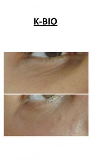 bezopasnaya-alternativa-botulotoksinu-in-ektsionny- miorelaksant-btx-tech-ot-k-surgery