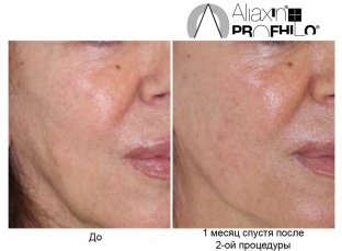 bioremodelirovanie-profhilo-kak-estestvennyj-protsess-omolozheniya-kozhi
