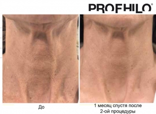 bioremodelirovanie-profhilo-kak-estestvennyj-protsess-omolozheniya-kozhi