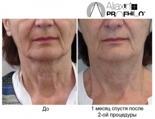 bioremodelirovanie-profhilo-kak-estestvennyj-protsess-omolozheniya-kozhi