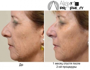 bioremodelirovanie-profhilo-kak-estestvennyj-protsess-omolozheniya-kozhi