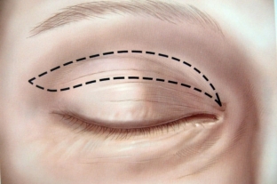 blefaroplastika-luchshij-sposob-otkryt-zerkalo-vashej-dushi