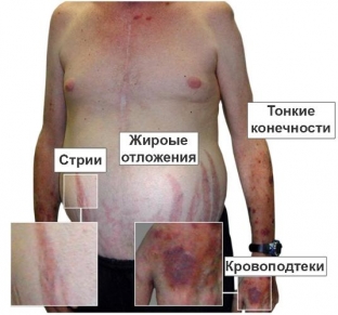 bolezn-itsenko-kushinga-budte-vnimatelny-k-striyam-na-tele