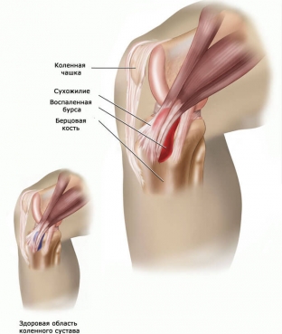 bursit-kolennoho-sustava-prichiny-i-metody-lecheniya