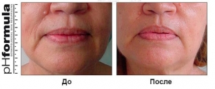 bystroe-prostoe-i-effektivnoe-obnovlenie-kozhi-k-letu- s-phformula-vitas