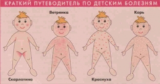 chem-otlichaetsya-syp-pri-raznykh-detskikh-infektsionnykh- /></p>
<p>Важливе значення має як характер і терміни появи висипу, а й її локалізація. Локалізація висипу при дитячих інфекційних хворобах:</p>
<ul>
<li>Кір – висип з'являється на обличчі та за вухами, поширюючись на тіло та руки.</li>
<li>Краснуха – висипання з'являються на обличчі, потім поширюється на все тіло. Є екзантеми на розгинальних поверхнях рук, енантеми на м'якому небі.</li>
<li>Скарлатина – елементи висипу відзначаються у всьому тілі, найбільш яскраво локалізуючись у складках. Єдине місце, де висип відсутня - носогубний трикутник.</li>
<li>Вітряна віспа – висипання на всьому тілі та обличчі, поширюючись на слизові оболонки.</li>
<li>Інфекційна еритема – висипка з'являється спочатку на щоках, поширюючись по всьому тілу.</li>
</ul>
<p>Окрім шкіри, при дитячих інфекційних хворобах, патологічним змінам підлягає і слизова оболонка.</p>
<div class=