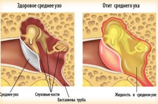 chto-delat-esli-zalozhilo-ukho-pri-prostude- i-реськіх-перепадах-давлення
