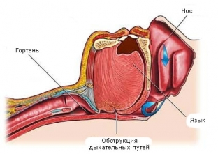 chto-meshaet-pokhudet-4-barera-na-puti-k-potere -vesa>До механічних бар'єрів, які заважають схуднути, відноситься і сонне апное, особливо якщо людина не здогадується про наявність такої проблеми. Недавні дослідження показали, що апное уві сні ускладнює втрату ваги, навіть якщо людина чітко дотримується наміченого плану харчування та тренувань.</p>
<p>Як подолати бар'єр? </p>
<p>Відповідь очевидна: позбутися болю, який заважає рухатися. Точно встановити причину виникнення болю та нейтралізувати його зможе кваліфікований фахівець. Якщо скинути вагу не вдається, і Ви постійно почуваєтеся стомленим і сонним, є сенс перевіритися на сонне апное.</p>
<h2>Що заважає схуднути: брак фінансових коштів</h2>
<p>У наш час багато людей стикаються з фінансовими труднощами. Деякі корисні продукти коштують недорого або ростуть безпосередньо на грядці – це сезонні фрукти та овочі. Однак є й такі, наприклад, червона риба, оливкова олія, креветки, на які може розщедритися не кожен. Що вже говорити про індивідуальне складання плану тренувань, власного тренера, походи в спортзали, спеціальний інвентар, обстеження, аналізи тощо.</p>
<p>Як подолати бар'єр? </p>
<p>Звичайно, на здоров'я економити не слід: будь-яких проблем зі здоров'ям краще позбуватися максимально швидко і рішуче. Щодо спортзалів, вони зовсім не обов'язкові, щоб займатися спортом. Так, під наглядом грамотного тренера краще, але за обмежених фінансових можливостей можна знайти й інші способи привести себе у форму: біг, стрибки на скакалці, планка, віджимання та багато інших вправ описані в інтернеті до найдрібніших подробиць!</p>
<h2>Що заважає схуднути: психологічні бар'єри</h2>
<p>Що заважає схуднути з психологічної точки зору? Депресія, дефіцит уваги, постійні стреси, звичка «заїдати» горе, тугу, нудьгу та інші негативні емоції. Існує також теорія, що іноді люди підсвідомо (тобто самі про те не здогадуючись) не бажають скидати вагу, оскільки для них він – щит, який захищає від негативних подій і людей. Крім цього, є свята, на які просто неможливо, на перший погляд, не наїдатись: Новий Рік, Великдень, Різдво.</p>
<p>Як подолати бар'єр? </p>
<p>Якщо Ви помічаєте, що саме психологічні бар'єри заважають схуднути, психологи зазвичай рекомендують робити записи. Заведіть собі журнал, в який записуватимете, що Ви їсте, коли, чому і в яких кількостях. Наприклад, якщо Ви потягнулися за чіпсами, тому що так цікавіше дивитися фільм, з'їли два шматки торта, тому що був важкий день, дозволили собі пиріг, щоб не образити господиню, або ж віддали перевагу салату, тому що це здорово і не завадить Вам позбутися від зайвих кілограмів.</p>
<p>Такий моніторинг емоцій та вживаних продуктів допоможе краще зрозуміти, коли Ви їсте, тому що голодні, а коли – від нудьги та інших факторів, з якими можна боротися іншими способами.</p>


                        


                                            </div>
                                        <div id=