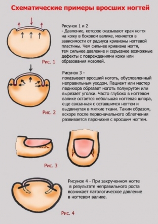 chto-provotsiruet-vrastanie-nogtej-i-kak-eto- predotvratit