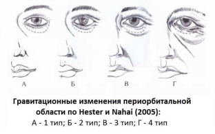 chto-vazhno-uchest-planiruya-khirurgicheskuyu-korrektsiyu-periorbit /></p>
<h2>Особливості будови верхньої та нижньої повіки</h2>
<p>Для виконання хірургічної корекції періорбітальної області та вік принципово важливо враховувати особливості будови верхньої та нижньої повіки. Для уточнення характеристик шарів верхньої повіки необхідно оцінити такі параметри:</p>
<ul>
<li>передня ламела – уточнюють наявність справжнього дермахалязису століття, особливості розташування тарзальної складки, стан кругового м'яза ока;</li>
<li>середня ламела – характеризують верхні жирові грижі;</li>
<li>задня ламела – оцінюють рівень положення війкового краю верхньої повіки по відношенню до зіниці і верхнього краю райдужної оболонки.</li>
</ul>
<p>У нижньому столітті важливо оцінити стан таких шарів:</p>
<ul>
<li>передню ламеллу, яка включає шкіру та круговий м'яз ока;</li>
<li>середню ламеллу – а саме її ретросептальну жирову клітковину і внутрішньоглазникову фасціальну перегородку;</li>
<li>задню ламеллу – опорні зв'язкові структури нижньої повіки, кон'юнктиву та нижній м'яз Мюллера.</li>
</ul>


                        

                        

                        <div id=