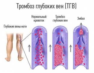 defitsit-kakogo-vitamina-yavlyaetsya-prichinoj-tromboza-glubokikh-ven