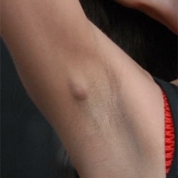 dejstvennye-metody-lecheniya-gidradenita-v-domashnikh-usloviyakh