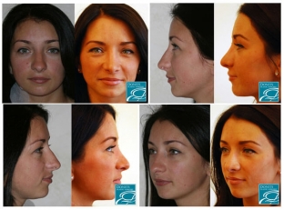 doktor-sdelajte-mne-krasivuyu nosa-nekotorye-sekrety-rinoplastiki