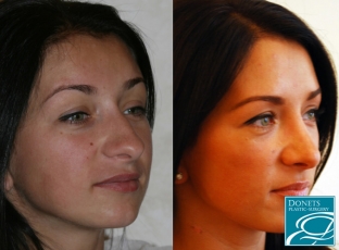 doktor-sdelajte-mne-krasivuyu nosa-nekotorye-sekrety-rinoplastiki