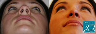 doktor-sdelajte-mne-krasivuyu-formu nosa-nekotorye-sekrety-rinoplastiki