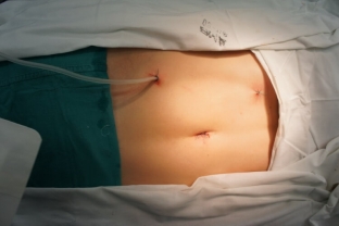 drenirovanie-ran-v-plasticheskoj-khirurgii-est-li-neobkhodimost