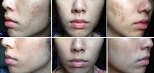 eksfoliatsiya-bez-problem-svojstva-mindalnogo-pilinga-dlya-litsa