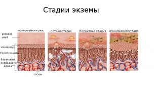 ekzema-trebuet-kompleksnoj-terapii-s-uchetom-individualnykh-osobennostej-si /></p>
<div class=