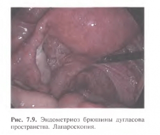 endometrioz-bryushiny-malogo-taza-kak-vyyavit-patologicheskij-protsess