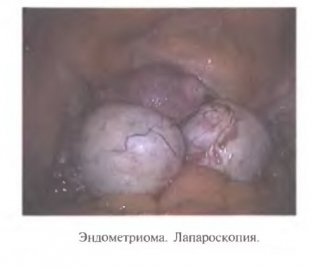 endometrioz-yaichnikov-kakimi-simptomami-mogut-proyavlyatsya-shokoladnye-kist </p>
</div>
<p>Пальпація є малоінформативною за наявності дрібних ендометріоїдних псевдокистів, але ендометріоми пальпаторно визначаються як тугоеластичні утворення, локалізовані кзади від матки, що обмежують її рухливість. Після менструації розмір ендометріом зростає.</p>
<p>При ультразвуковому дослідженні про наявність псевдокист можуть говорити гіпоехогенні включення на поверхні яєчників та потовщення їх білкової оболонки внаслідок формування спайок.</p>
<p>Ендометріоми при ультразвуковому дослідженні візуалізуються як округлі утворення з вираженою ехопозитивною капсулою, локалізовані позаду матки, що мають дрібнодисперсну ехопозитивну суспензію на тлі рідкого вмісту.</p>
<p>Лапароскопія дозволяє не тільки уточнити діагноз ендометріозу яєчників, але й провести безпосередньо лікування цієї патології.</p>


                        

                        

                        <div id=