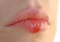 esteticheskie-protsedury-i-virus-prosto-gerpesa-kak-izbezhat-oslozhnenij /></p>
<div class=