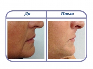 filler-na-osnove- gialuronovoj-kisloty-s-nanosfernymi-chastitsami-kak-eto-rabotaet