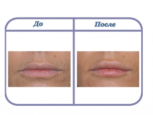 filler-na-osnove- gialuronovoj-kisloty-s-nanosfernymi-chastitsami-kak-eto-rabotaet