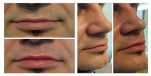 idealnye-guby-pravila-i-sredstva-garmonichnoj-kosmeticheskoj-korrektsii