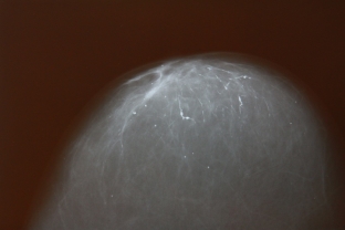 involyutsiya-molochnoj-zhelezy-diagnoz-ili-sostoyanie