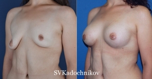 izbezhat-oslozhnenij-posle-plastiki-grudi-pomozhet-tschchatelnaya-podgotovka