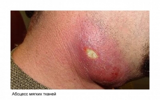 kak-opredelit-simptomy-razvivayushchegosya-abstsessa