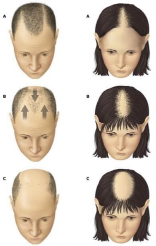kak-ostanovit-vypadenie-i-vosstanovit rost-volos-metody-lecheniya-alopetsii