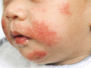 kak-pravilno-diagnostirovat-pishchevuyu-allergiyu