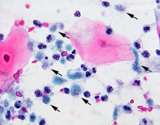 kak-pravilno-diagnostirovat-urogenitalny-trikhomoniaz