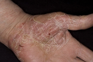 kak-proyavlyayutsya-allergicheskie-dermatozy-osobennosti-klinicheskoj-kart
<blockquote>
<p>Залежно від клінічної картини, фахівець може визначити форму алергічного дерматиту, та призначити пацієнту ефективну схему лікування. </p>
</blockquote>
<p>Спасибі за те, що ви залишаєтеся з estet-portal.com. Ваші запитання, зауваження та відгуки залишайте у коментарях до цієї статті.</p>
<p>Читайте також: <a href=