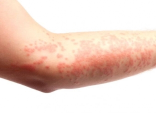 kak-proyavlyayutsya-allergicheskie-dermatozy-osobennosti-klinicheskoj</a>
<ul>
<li>при <a href=
