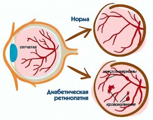 kakie-izmeneniya-glaznogo-dna-svidetelstvuyut-o-diabetichkoj
