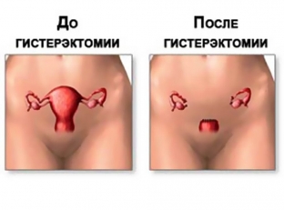 kakie-nepriyatnye-simptomy-mogut-bespokoit-zhenshchinu-posle-gisterek
                        ></p>
<h2>Принципово значущі класифікації постгістеректомічного синдрому</h2>
<p>Існує дві принципово значущі класифікації постгістеректомічного синдрому: за часом виникнення та за клінічним перебігом захворювання. За часом виникнення розрізняють: </p>
<ul>
<li>ранній постгістеректомічний синдром – перші симптоми після гістеректомії виникають з першого дня післяопераційного періоду;</li>
<li>пізній постгістеректомічний синдром розвивається в інтервалі від одного місяця до одного року після гістеректомії.</li>
</ul>
<p>Залежно від клінічного перебігу виділяють:</p>
<ul>
<li>транзиторний постгістеректомічний синдром – характеризується відновленням функції яєчників протягом 1 місяця – 1 року після операції, спостерігається у 80% пацієнток віком від 37 до 47 років;</li>
<li>стійкий постгістеректомічний синдром характеризується наявністю гіпоестрогенії протягом більш ніж одного року після гістеректомії, зустрічається у 20% пацієнток, найчастіше віком від 46 до 52 років.</li>
</ul>
<h2>Клінічна картина: які симптоми виникають після гістеректомії</h2>
<p>Клінічна картина постгістеректомічного синдрому характеризується розвитком, головним чином, психоемоційних та вегетоневротичних порушень. Як прояв порушень психіки у більшості пацієнток виникає депресивний стан після гістеректомії зі скаргами на стомлюваність, слабкість, млявість, поганий настрій, зниження працездатності тощо. Набагато рідше у пацієнток відзначається тривожний стан із необґрунтованим страхом раптової смерті. Досить часто у пацієнток відзначаються скарги на страх розпаду сім'ї у зв'язку зі зниженням власної сексуальності, на ґрунті чого може виникати пригнічення лібідо та погіршення якості сексуального життя жінки. Вегетоневротичні порушення після гістеректомії виявляються такими симптомами:</p>
<ul>
<li>приступи серцебиття;</li>
<li>озноб та мерзлякуватість;</li>
<li>відчуття повзання мурашок по шкірі;</li>
<li>погана переносимість високих температур;</li>
<li>припливи;</li>
<li>підвищена пітливість;</li>
<li>порушення сну;</li>
<li>набряки;</li>
<li>транзиторна гіпертензія.</li>
</ul>


                        

                        

                        <div id=