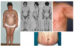 kakie-proyavleniya-sindroma-kushinga-pri-kortikosterome