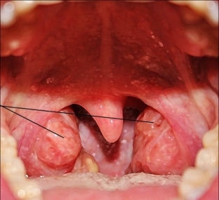 kakie-simptomy-adenoidov-u-rebenka-trebuyut-obrashcheniya-k- doktoru