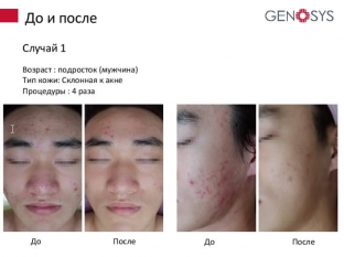 kogda-svetoizluchenie-polezno-dlya-kozhi-fototerapiya-s-lampoj-geno led